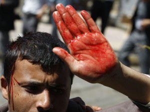 An anti-government protester gestures after he was injured during clashes with government backers in Sanaa